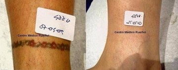 1428393003_Eliminaci_n_de_tatuaje_CMR