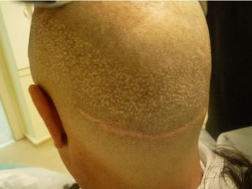 1461613420_injerto_capilar_mal