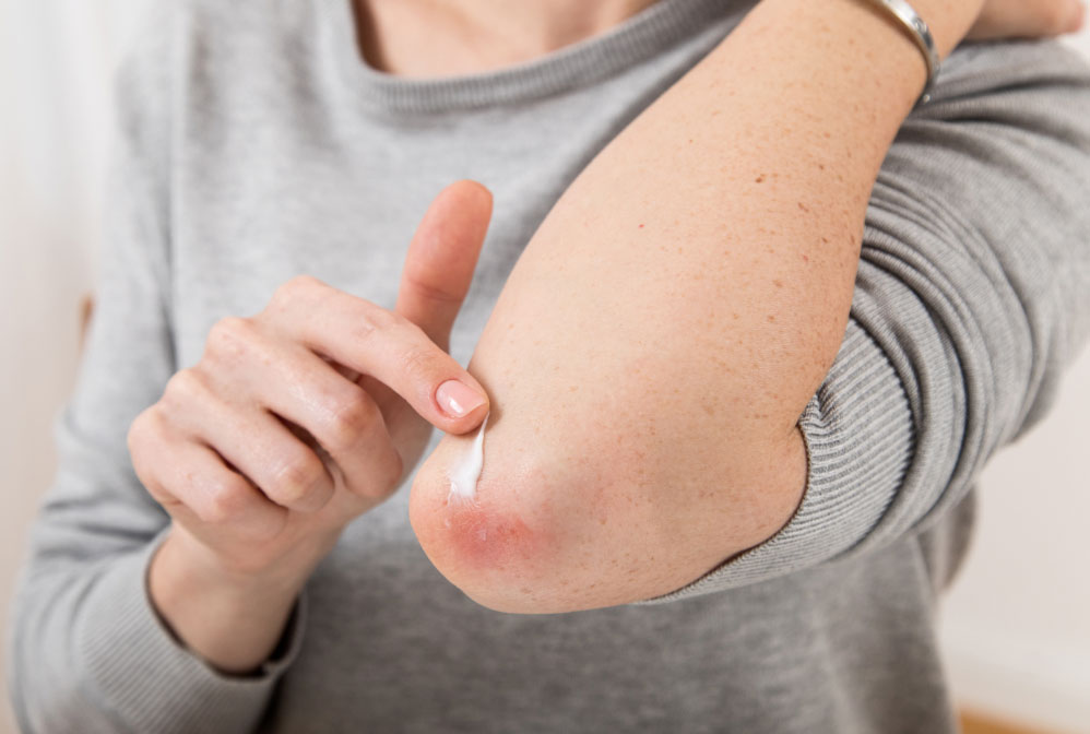 psoriasis El Digital de Asturias