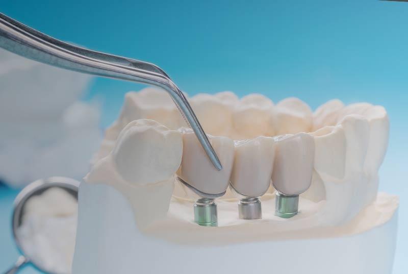 implantes  El Digital de Asturias