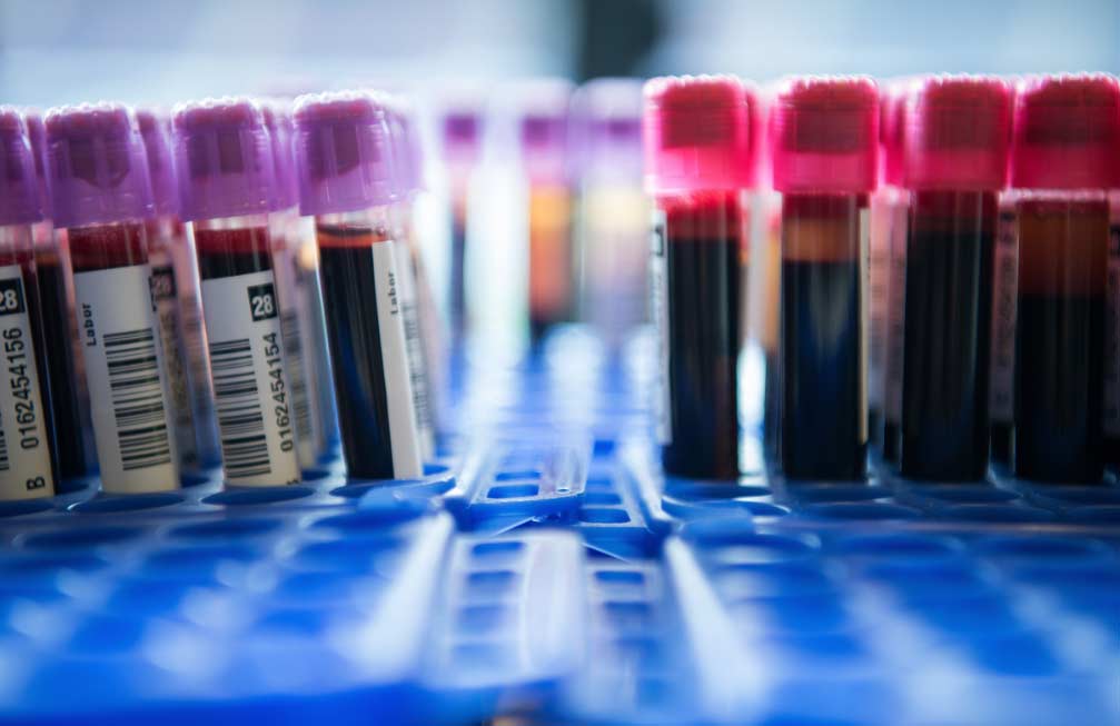 Liquid biopsy El Digital de Asturias Liquid biopsy