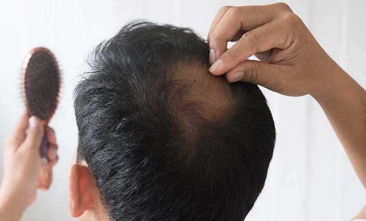 alopecia El Digital de Asturias alopecia