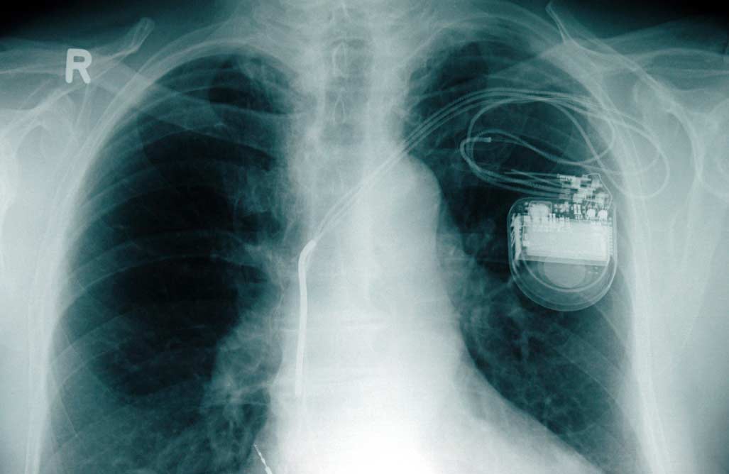 marcapasos  El Digital de Asturias marcapasos